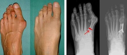 Symptômes de l'hallux valgus