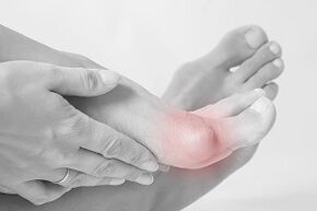 Hallux valgus Comment choisir ses chaussures