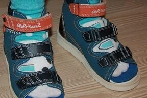 Porter des sandales pour hallux valgus chez un enfant