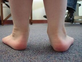 Déformation du pied plat en valgus chez un enfant