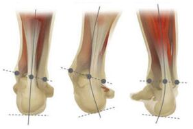 Pied normal avec déviation valgus et varus de l'os du talon