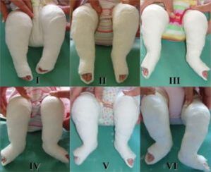 Procédures de plâtre, dont chacune change la position du pied