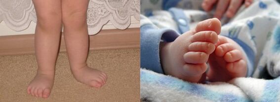 Déformation valgus du pied