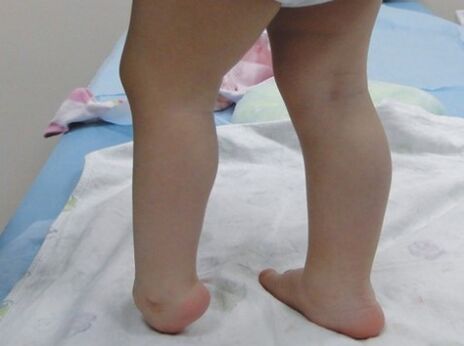 Les premiers symptômes de la déformation valgus du pied