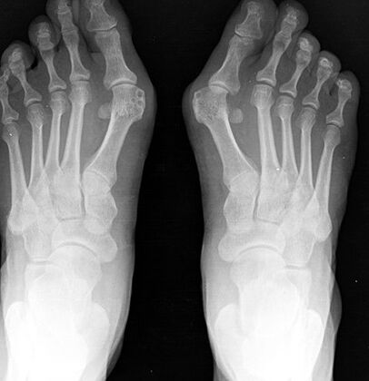 X -ceau du pied